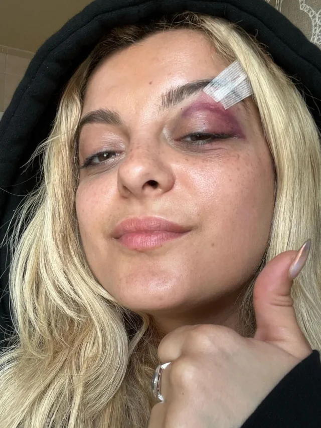 Bebe Rexha Hurried Off Stage In the wake of Getting Hit in the Head by Telephone