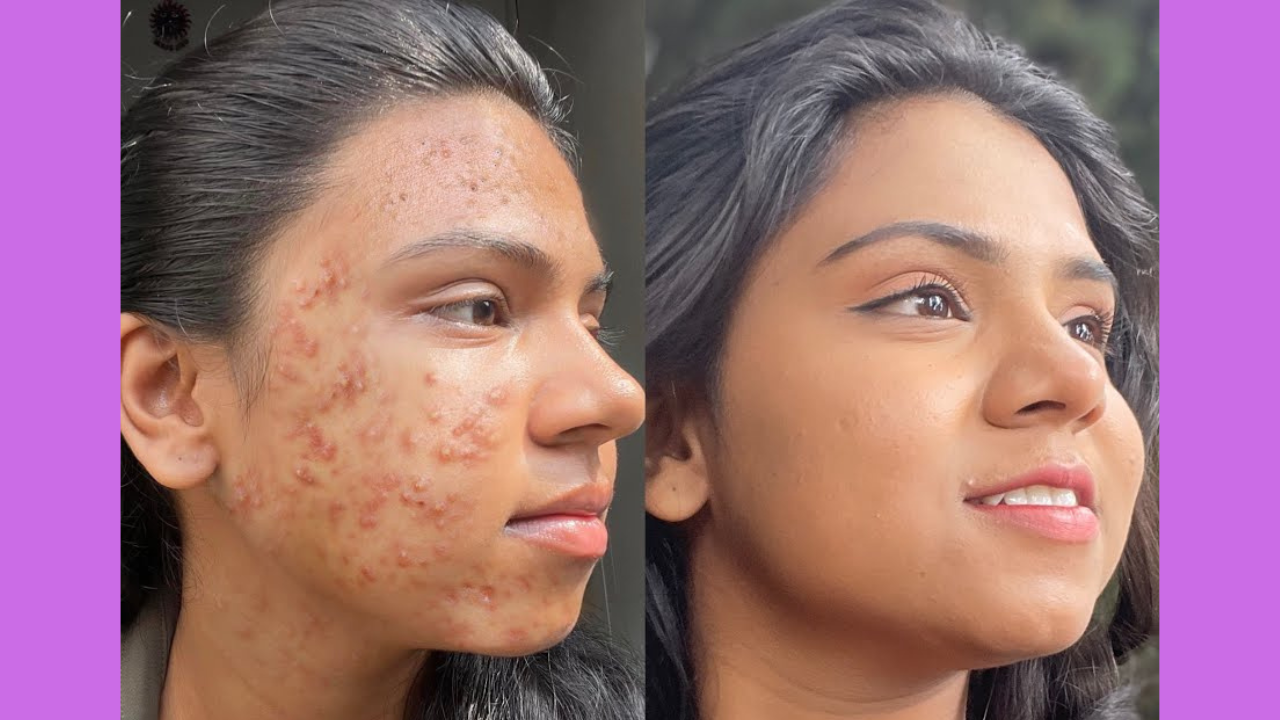 Achieving Model-Like Glass Skin with Tretinoin and a Simple Routine